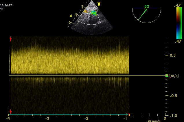 IVC cannula malpos flow after.jpg