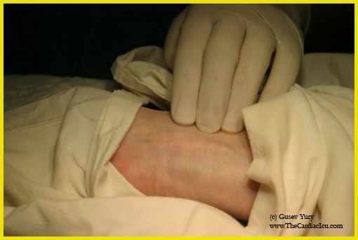 radial_palpation